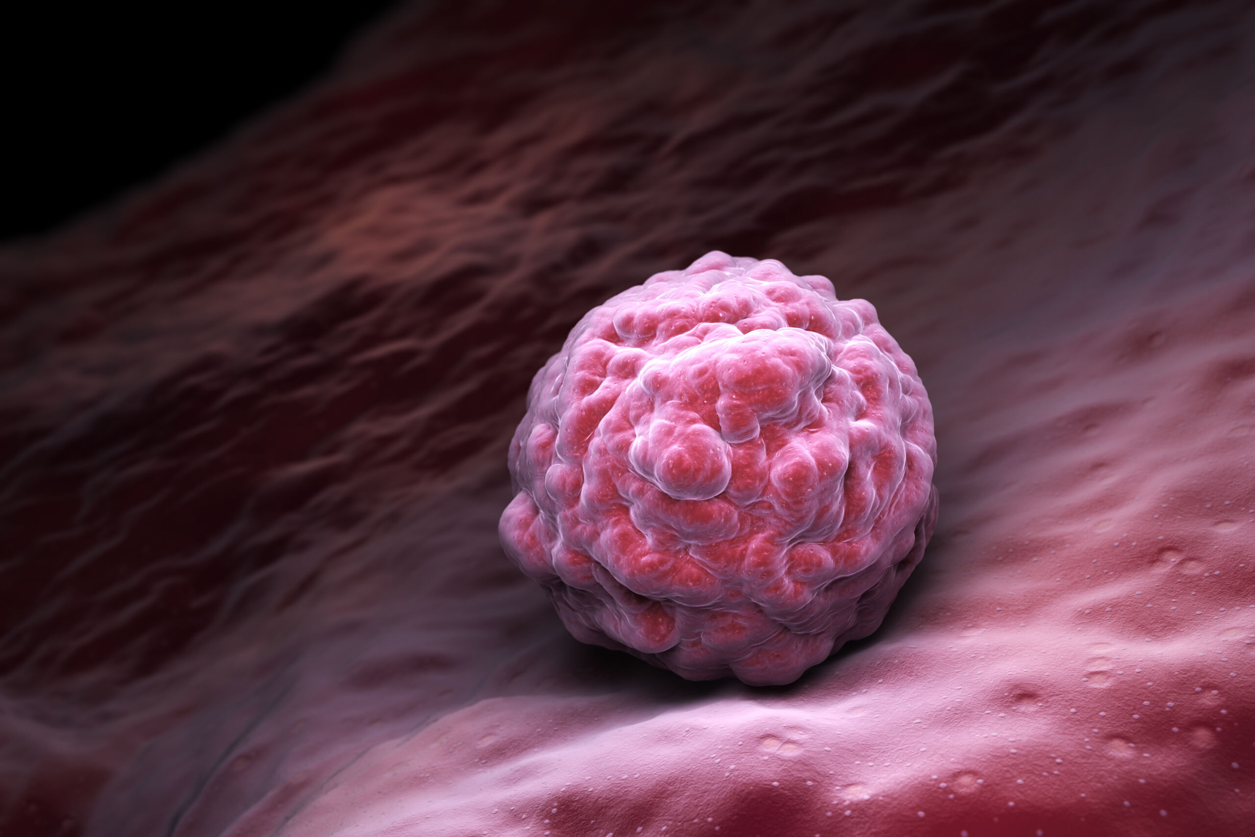 Fledgling AI trial spots breast cancer